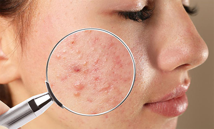 Fungal-Acne-Vs-Closed-Comedones