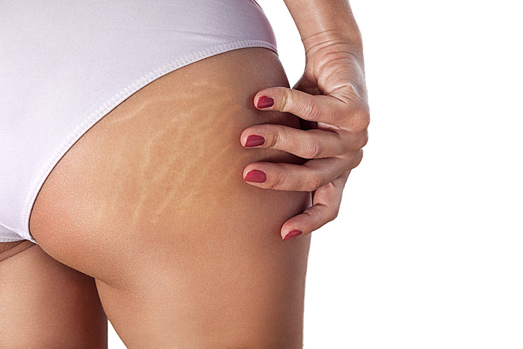 microneedling-stretch-marks