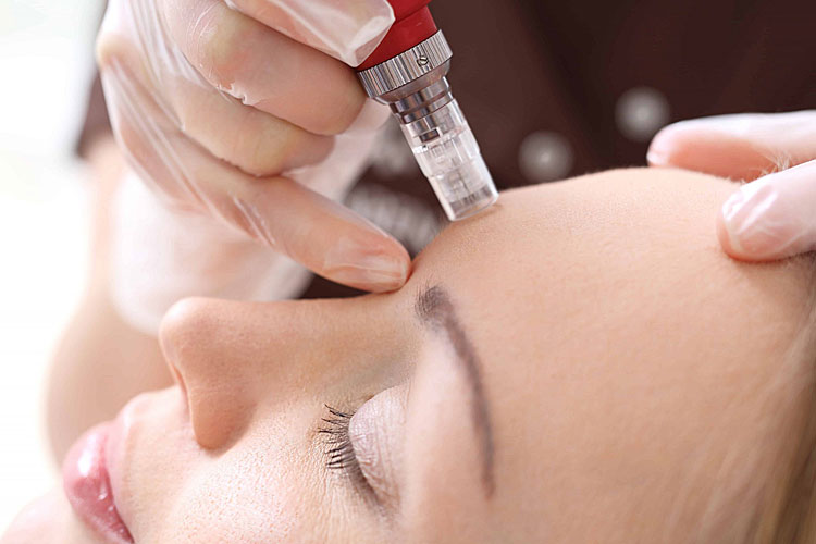 microneedling-for-open-pores