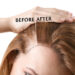 No Shave Fue Hair Transplant: Stress Free Hair Restoration.